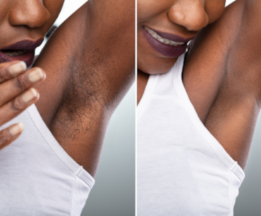 Épilation au laser (Laser Cutera® XEO:YAG)