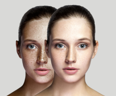 Photorajeunissement (IPL)