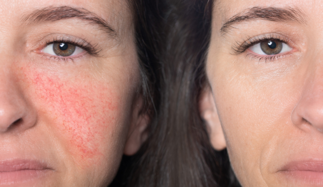 Traitement laser vasculaire au visage